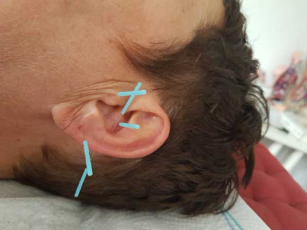 Akupunktur und Akupressur - Akupunkturpunkte am menschien Ohr